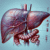 Advanced Liver Blood Test Insights: Tewkesbury Analysis